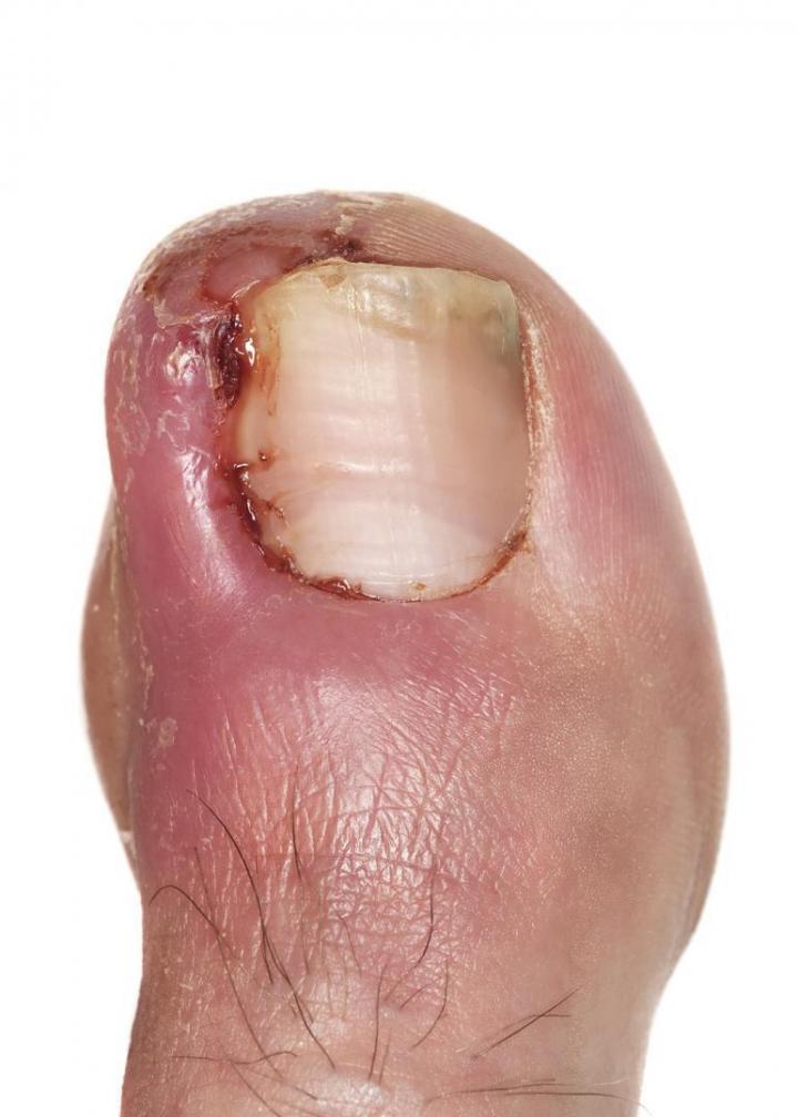 Traitement et soin des ongles incarnés Clermont-Ferrand