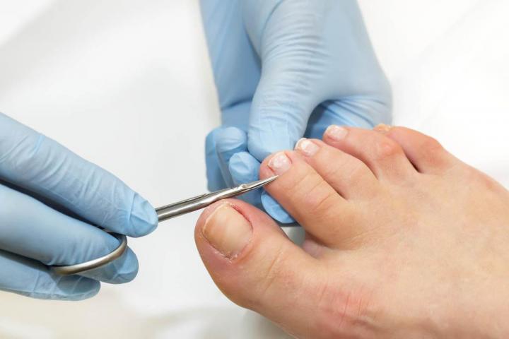 Spécialisé dans le traitement des ongles incarnés